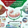 Phục Hình Trên Implant Cần Lưu Ý Những Gì? | Mỹ Luân Dental Lab