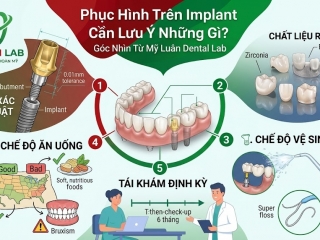 Phục Hình Trên Implant Cần Lưu Ý Những Gì? | Mỹ Luân Dental Lab