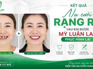 Cách sửa bọc răng sứ hỏng, Mỹ Luân Lab, bọc răng sứ bị viêm lợi, làm lại răng sứ hỏng.