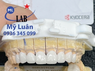 PHỤC HÌNH SỨ HT SMILE