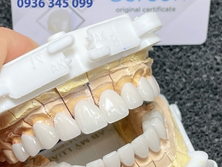 Phục Hình Sứ Cercon HT