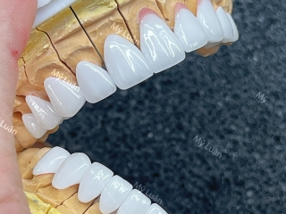 PHỤC HÌNH RĂNG SỨ DDBIO