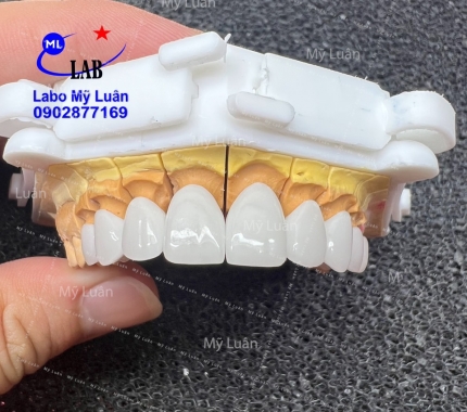 Sứ Lava vừa hoàn thành. khi  Bác Sĩ yêu cầu đây là bệnh nhân nữ và đây là kết quả.