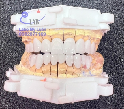 Một ca sứ cercon vừa hoàn thành. Khi bác sĩ nói bệnh nhân thích trắng.