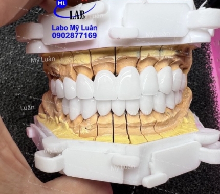 Dòng sứ siêu trắng không làm bệnh nhân thất vọng.