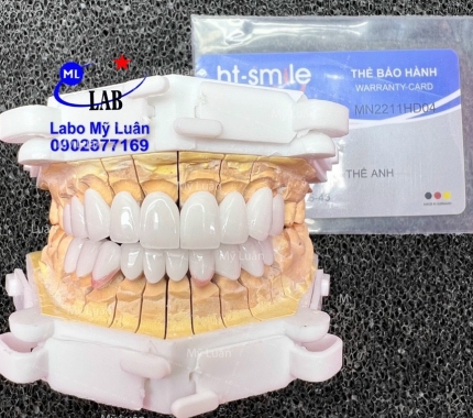 Một ca thẩm mỹ  xịn xò được hoàn thành . HT Smile là dòng sứ cao cấp đang được ưa chuộng trên thị trường, với độ vượt trội và độ bền cao.