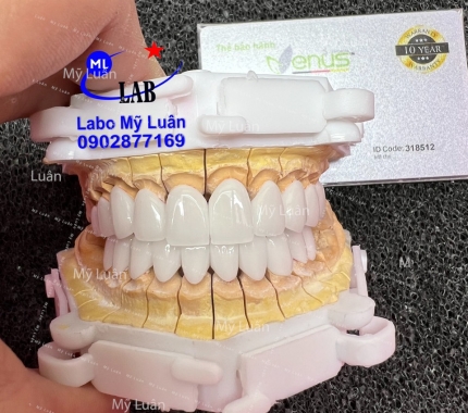 Sứ  Venus thẩm mỹ, hoàn thành vào ngày cuối tuần.