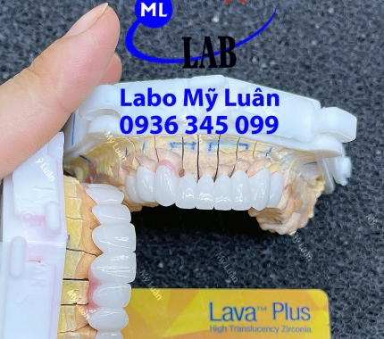Cảm ơn quý khách hàng đả tin tưởng LAB MỸ LUÂN và chúng tôi đả tạo ra một tuyệt phẩm như thế này để quý khách hàng thêm tự tin.
