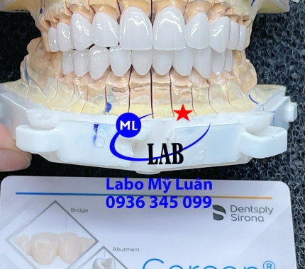 Răng sứ CERCON HT luôn sinh ra những sản phẩm tuyệt vời như thế này.