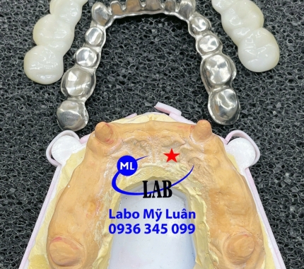 Thanh T-Bar dành cho phục hình mất răng toàn hàm.
