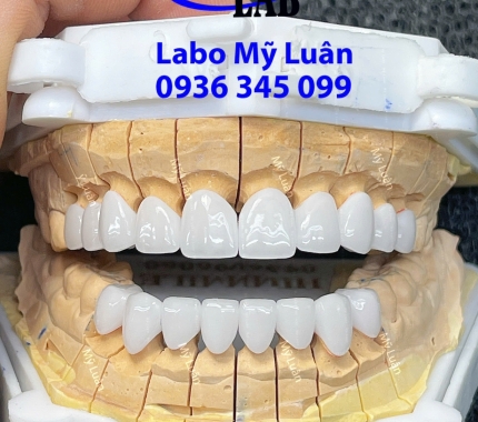 LAB MỸ LUÂN sẽ mang lại cho bạn một hàm răng trắng sáng.