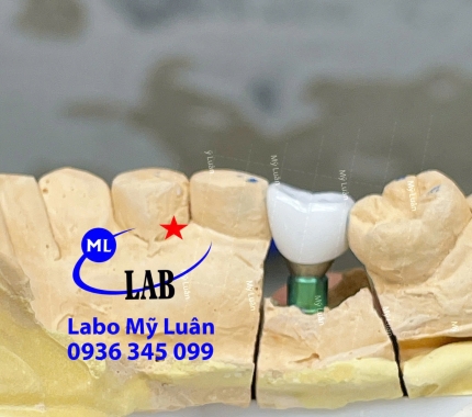 Hoàn thiện 1 ca Implant cho khách iu.