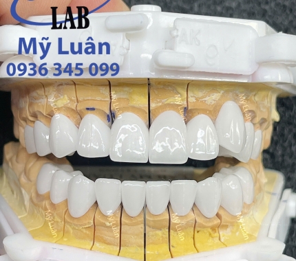 Mẫu răng LAVA khễnh duyên dáng .