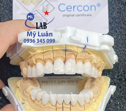 Sáng nay lại hoàn thiện thêm một ca thẩm mỹ từ dòng sứ cao cấp Cercon HT.