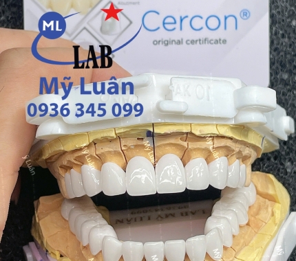 Cercon HT không làm ta thất vọng.