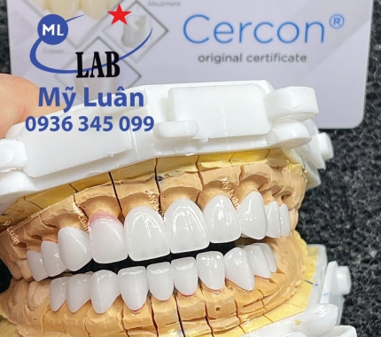 Một hàm Cercon HT trắng sáng cho khách đây 