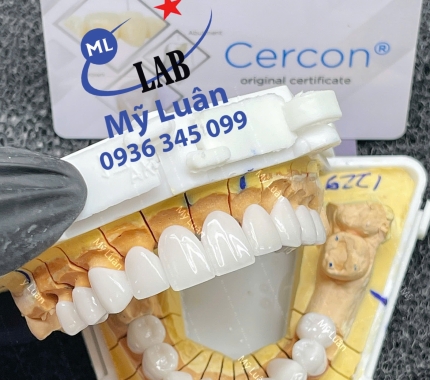 Kiệt tác CERCON HT với hàm thẩm mỹ cực nét.