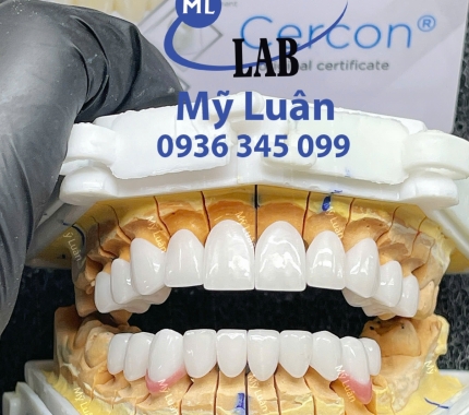 CERCON HT nâng tầm đẳng cấp nụ cười của bạn.