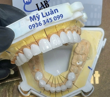 Orodent White Matt đẳng cấp vươn tầm.
