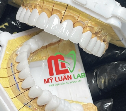 Đầu tuần răng sứ thẩm mỹ LAB MỸ LUÂN vẩn rạng ngời.